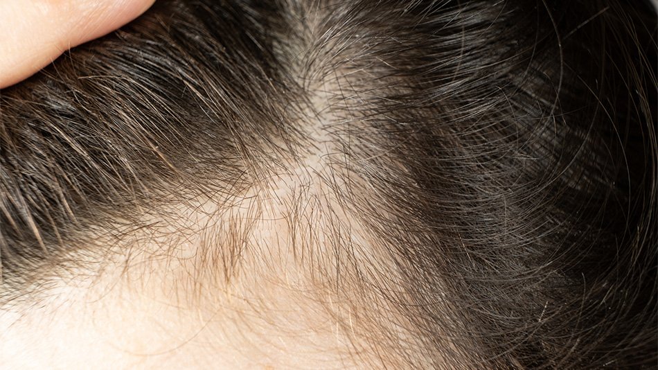 Zbliżenie na czoło przy linii włosów i widoczne krótkie baby hair