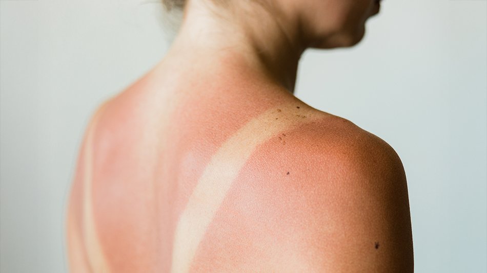 kobieta z oparzeniem słonecznym na plecach