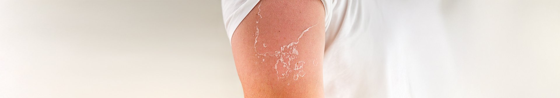 sucha skóra po opalaniu