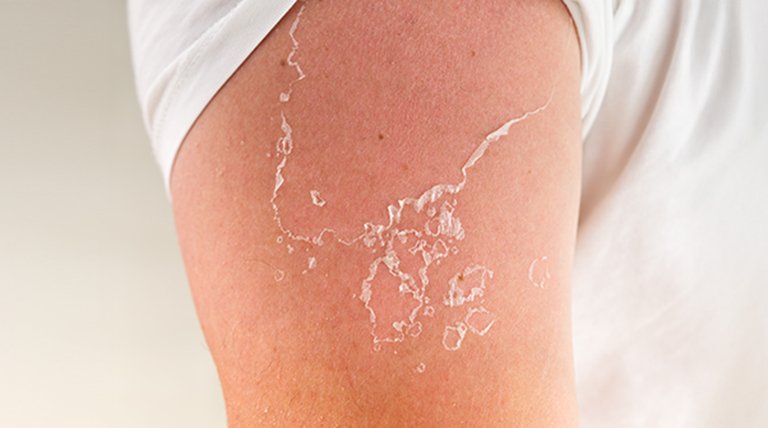 sucha skóra po opalaniu