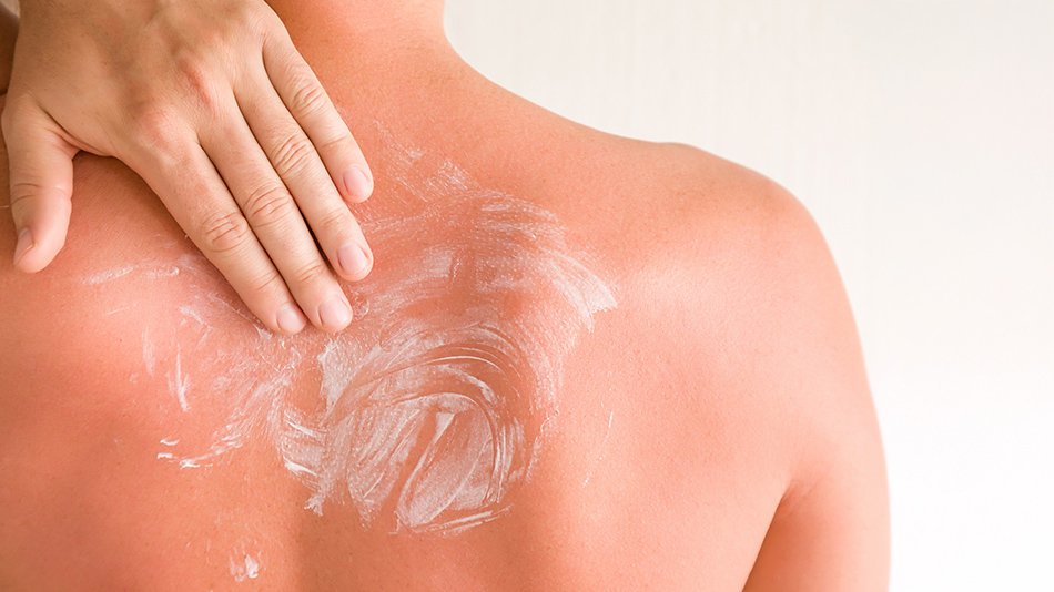 pielęgnacja skóry przy oparzeniu słonecznym I stopnia