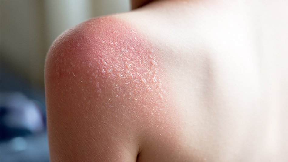 oparzenie słoneczne II stopnia