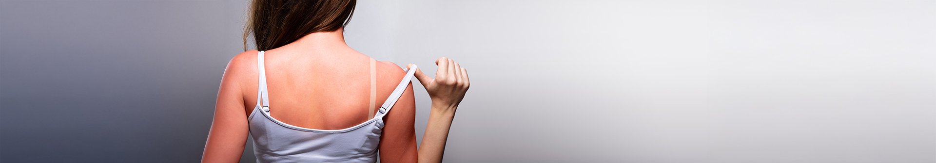 dziewczyna z oparzeniem słonecznym na plecach